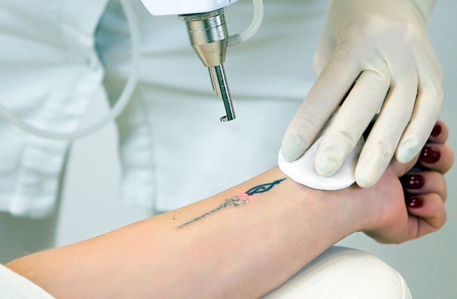 Лазерное удаление татуировок: что нужно знать